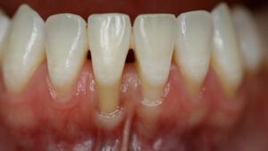 What is gum recession, its causes, preventive measure, sign to diagnose and its treatment.