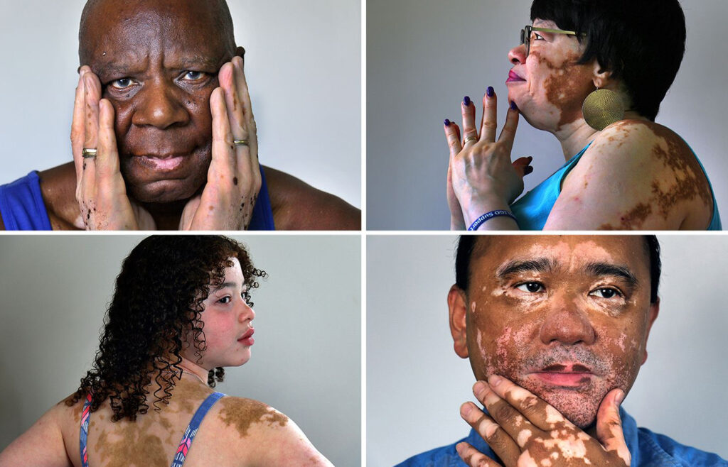 What-is-vitiligo-its-pathogenesis-types-diagnosis-complications-prevention-and-treatment